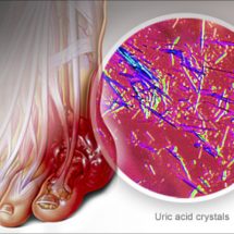 How To Eliminate Uric Acid Crystals in Joints – Gout and Joint Pain