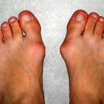 Get Rid of Hallux Valgus Deformity in 10 days Without a Surgery