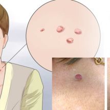 5 Effective Home Remedies to Help Remove Skin Tags Without Seeing a Doctor