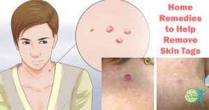 5 Effective Home Remedies to Help Remove Skin Tags Without Seeing a Doctor