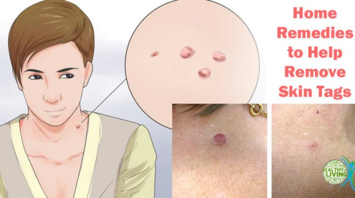 5 Effective Home Remedies to Help Remove Skin Tags Without Seeing a Doctor