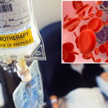 Chemotherapy Is Spreading Cancer Instead of Stopping It