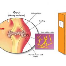 Prevent Gout and Joint Pain by Removing Uric Acid Crystals from Your Body!