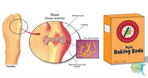 Prevent Gout and Joint Pain by Removing Uric Acid Crystals from Your Body!