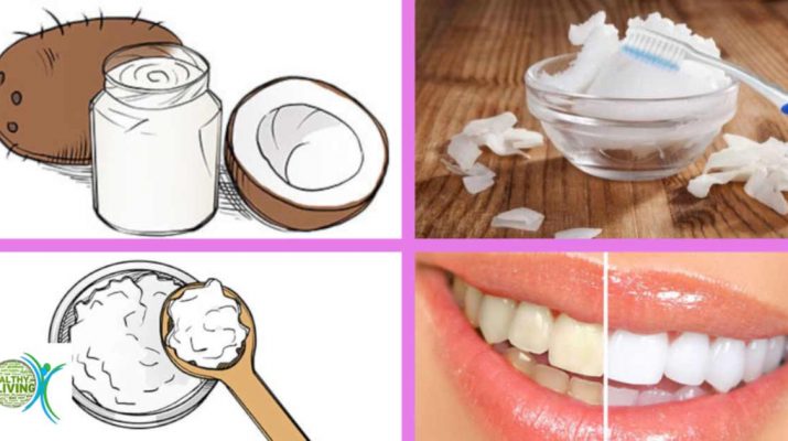 Use Coconut Oil to Reverse Cavities and Tooth Decay Naturally!