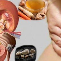 2 Effective Ways to Get Rid of Kidney Stones Naturally
