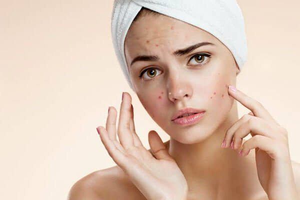 How-to-Get-Rid-of-Pimples-in-summer