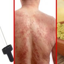 Natural Remedies to Treat Eczema