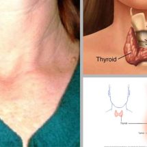 12 Symptoms of Thyroid Disorder Million Women Ignore