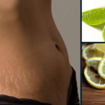 Best Home Remedies to Remove Stretch Marks