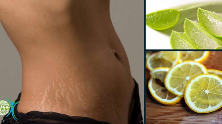 Best Home Remedies to Remove Stretch Marks