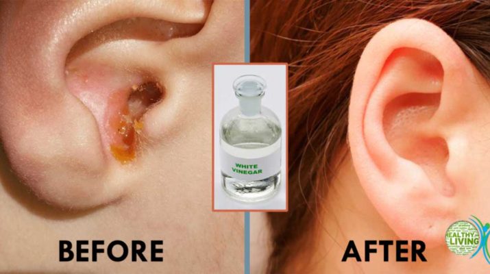 The Easiest Method To Clean Your Ears Naturally!