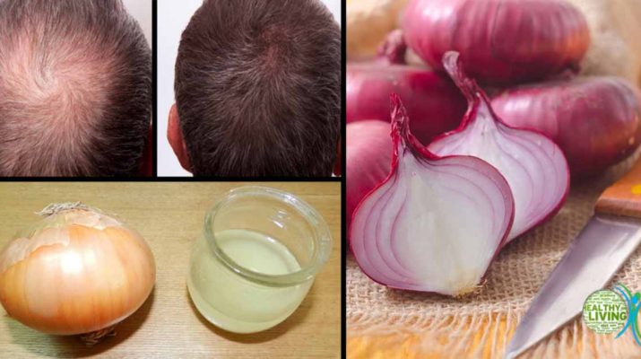 3 Ways Onion Juice Can Be Useful for Your Hair, Including Hair Growth