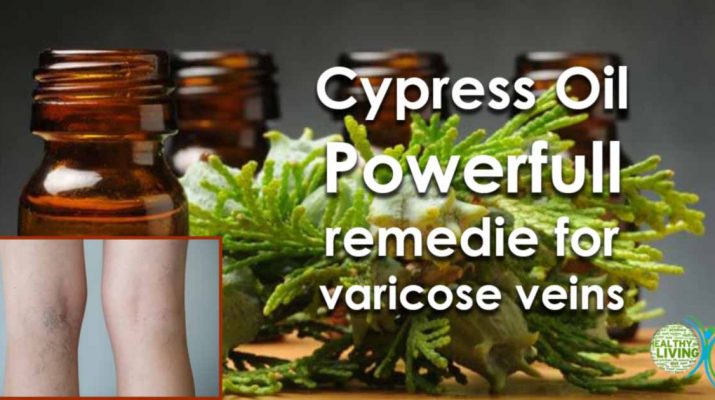 Get Rid of Varicose Veins with These Powerful Essential Oils