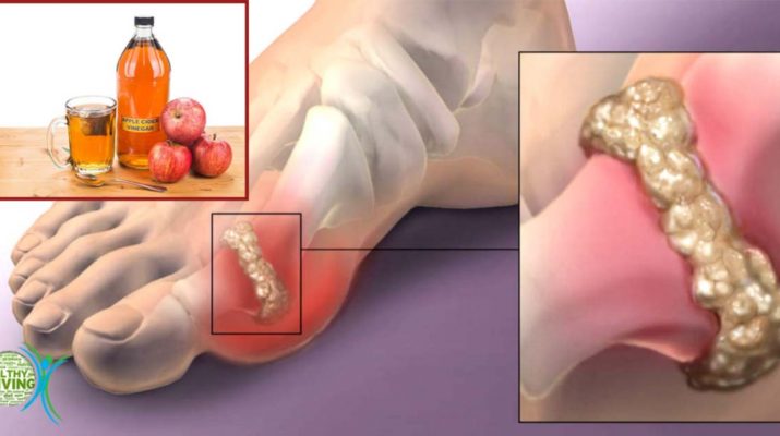 Try This Ingredient to Relieve Joint Pains and Lower Uric Acid Levels