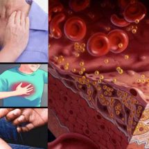 Possible Signs of High Cholesterol