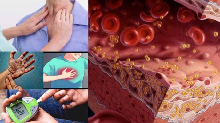 Possible Signs of High Cholesterol