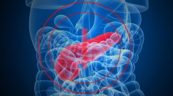Watch Out for These Signs of Pancreatic Cancer