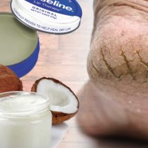 Incredible Ways to Treat Cracked Heels At Home