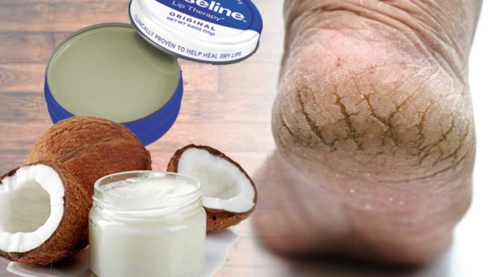 Incredible Ways to Treat Cracked Heels At Home