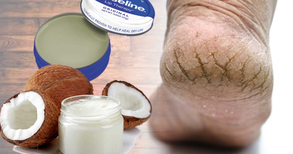 Incredible Ways to Treat Cracked Heels At Home.