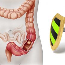 Best Tips to Prevent Colon Cancer