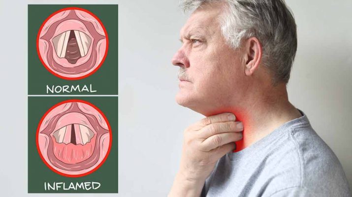 Laryngitis Symptoms and Home Remedies