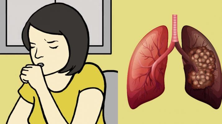 8 Signs of Lung Cancer Women Should Know About