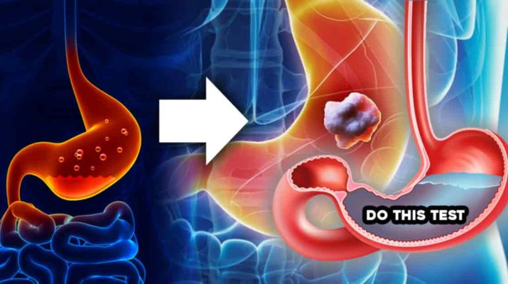 Low Stomach Acid Test