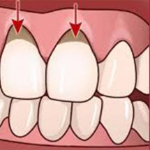 4 Natural Remedies to Grow Back Those Receding Gums