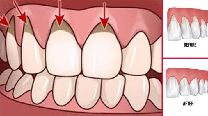 4 Natural Remedies to Grow Back Those Receding Gums