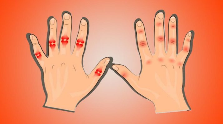 Best Natural Remedies and Exercises for Relieving Arthritis Hand Pain