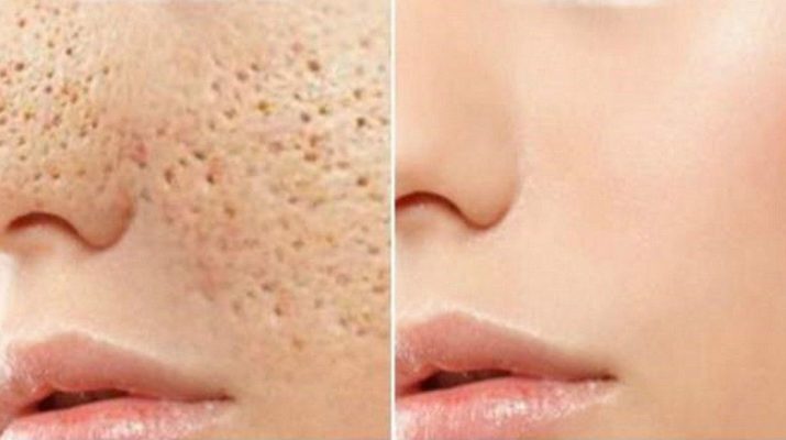 Simple Natural Face Masks to Get Rid of Pores Without Paying Hundreds of Dollars