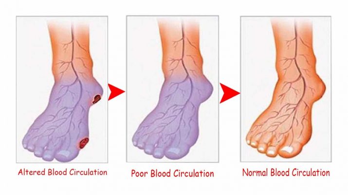 Do You Suffer from Poor Circulation? Here’s How to Solve the Problem in Only 30 Minutes!