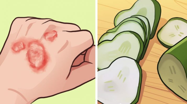 Don't Feel Embarrassed by Eczema. Battle It With These 6 Home Remedies