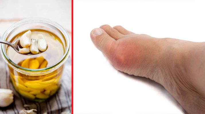 Reduce Inflammation in Varicose Veins with Homemade Garlic Oil