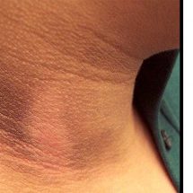 A 15-Minute Treatment for Dark Spots on the Neck, Inner Thighs and Underarms