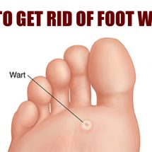 Easy Ways to Get Rid of Warts on the Bottom of the Foot
