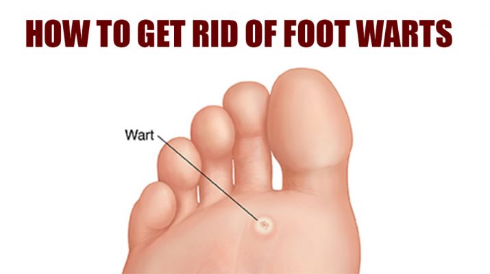 Easy Ways to Get Rid of Warts on the Bottom of the Foot