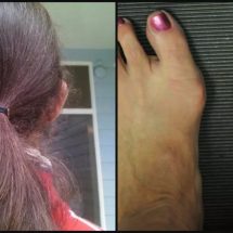 Prevent Painful Bunions Only by Using a Hair Band… and 7 Other Tips!