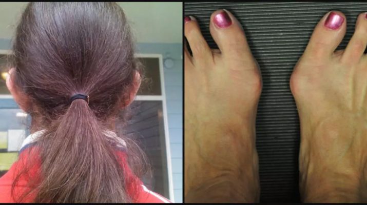 Prevent Painful Bunions by Only Using a Hair Band