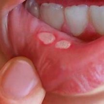 How to Eliminate Canker Sores Naturally