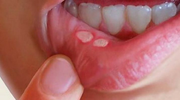 How to Eliminate Canker Sores Within Months Naturally