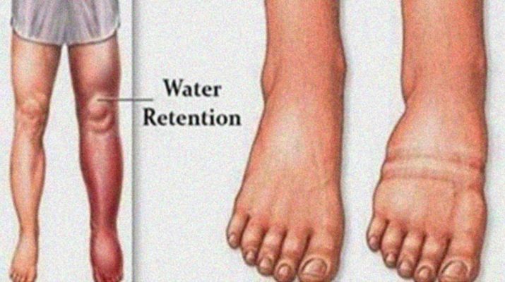 The Signs Behind Water Retention and How to Stop It