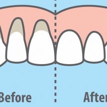 10 Easy Ways to Heal Receding Gums Naturally