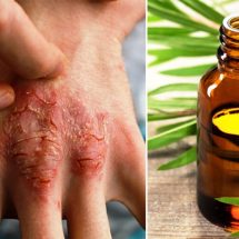 The Essential Oil That Fights Acne, Eczema & Psoriasis