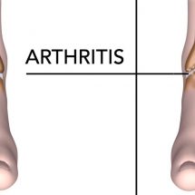 5 Foods That Help Reduce Arthritis Pain