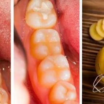 How to Heal Cavities and Tooth Decay Naturally with These Home Remedies