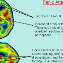 Panic Attacks and #Anxiety linked to low vitamin B and #Iron levels