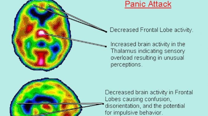 Panic-Attacks-and-#Anxiety-linked-to-low-vitamin-B-and-#Iron-levels